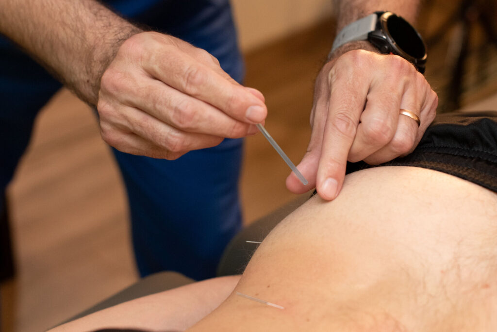 Dry needling